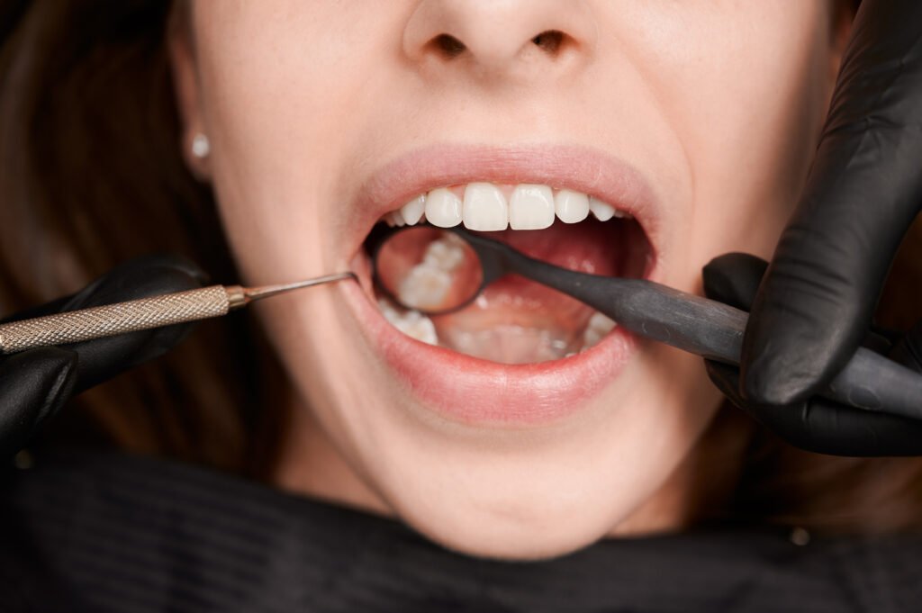 bleeding gums treatment by dentist